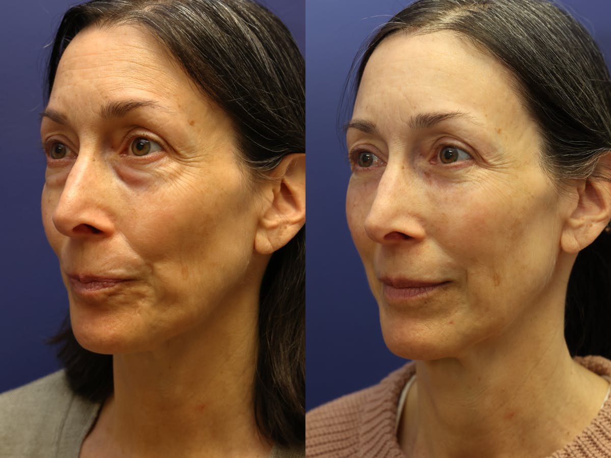 Facial Revolumizing (Fat Transfer) Before & After Gallery - Patient 250565 - Image 4