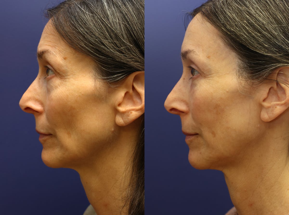 Facial Revolumizing (Fat Transfer) Before & After Gallery - Patient 250565 - Image 5