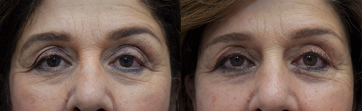 Upper Eyelid Ptosis Repair Before & After Gallery - Patient 292526 - Image 1