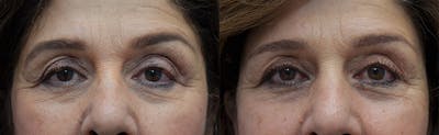 Upper Eyelid Ptosis Repair Before & After Gallery - Patient 292526 - Image 1