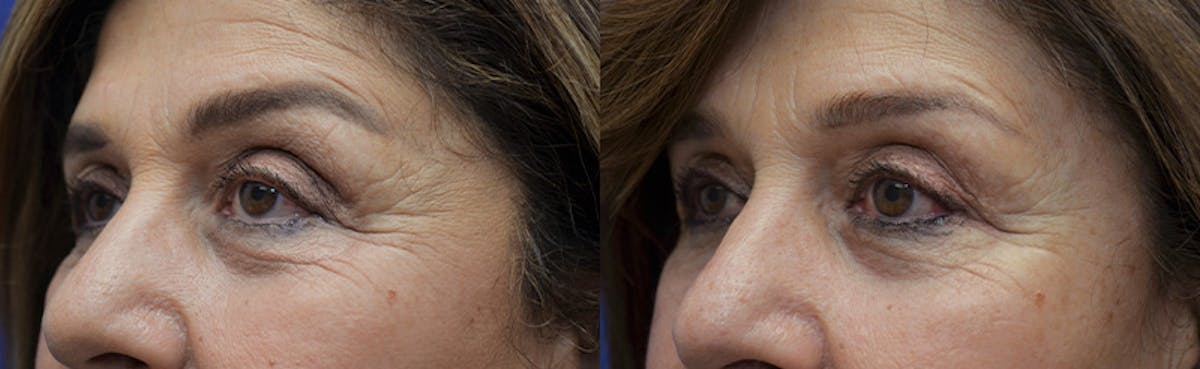Upper Eyelid Ptosis Repair Before & After Gallery - Patient 292526 - Image 2