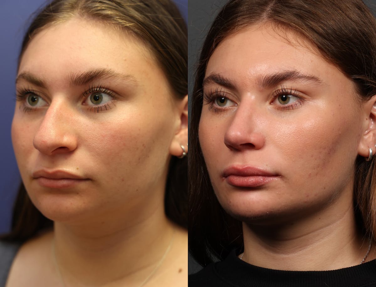 Rhinoplasty Before & After Gallery - Patient 103600 - Image 1