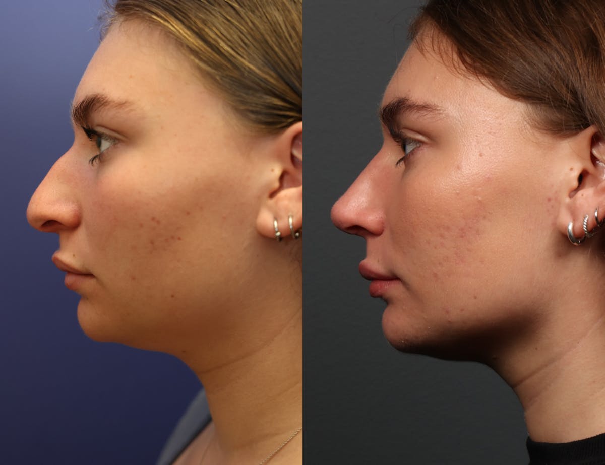 Rhinoplasty Before & After Gallery - Patient 103600 - Image 4