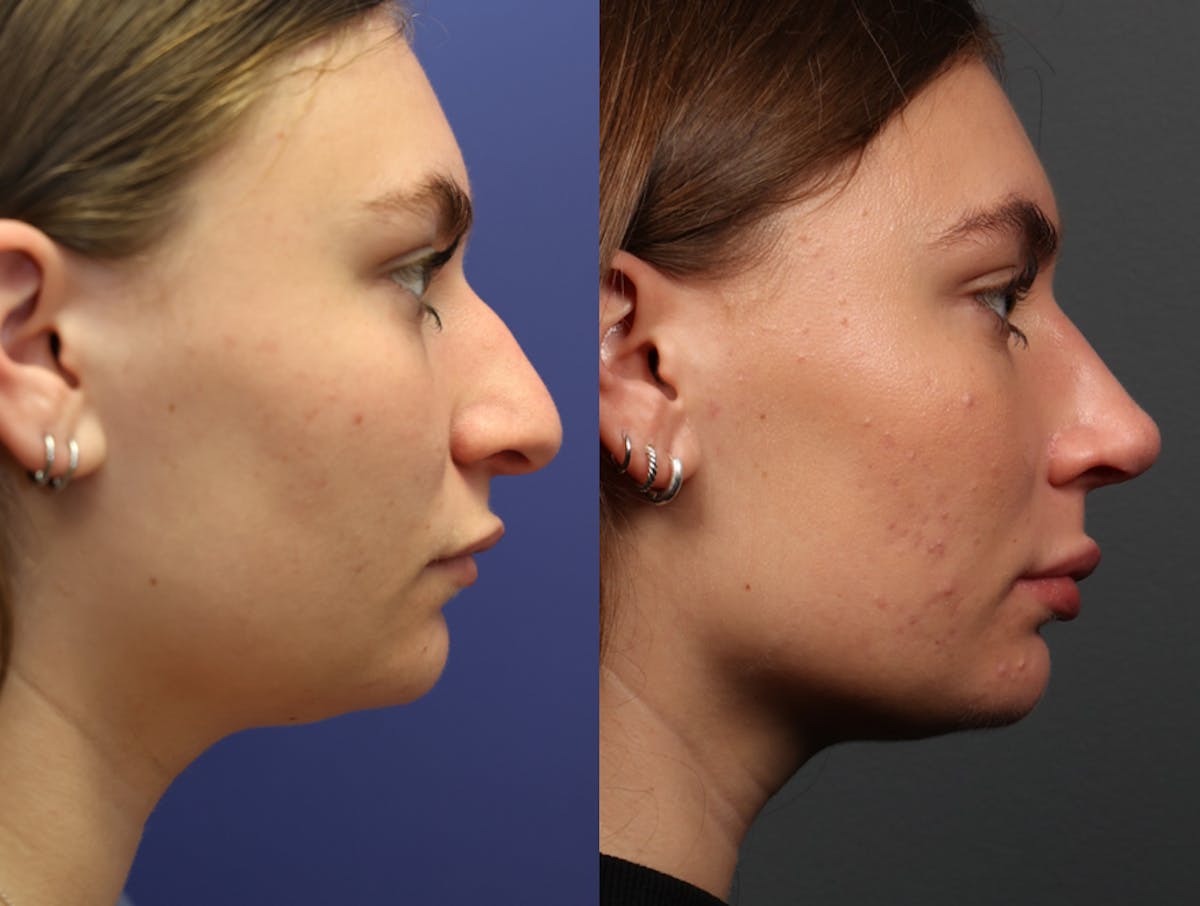 Rhinoplasty Before & After Gallery - Patient 103600 - Image 5