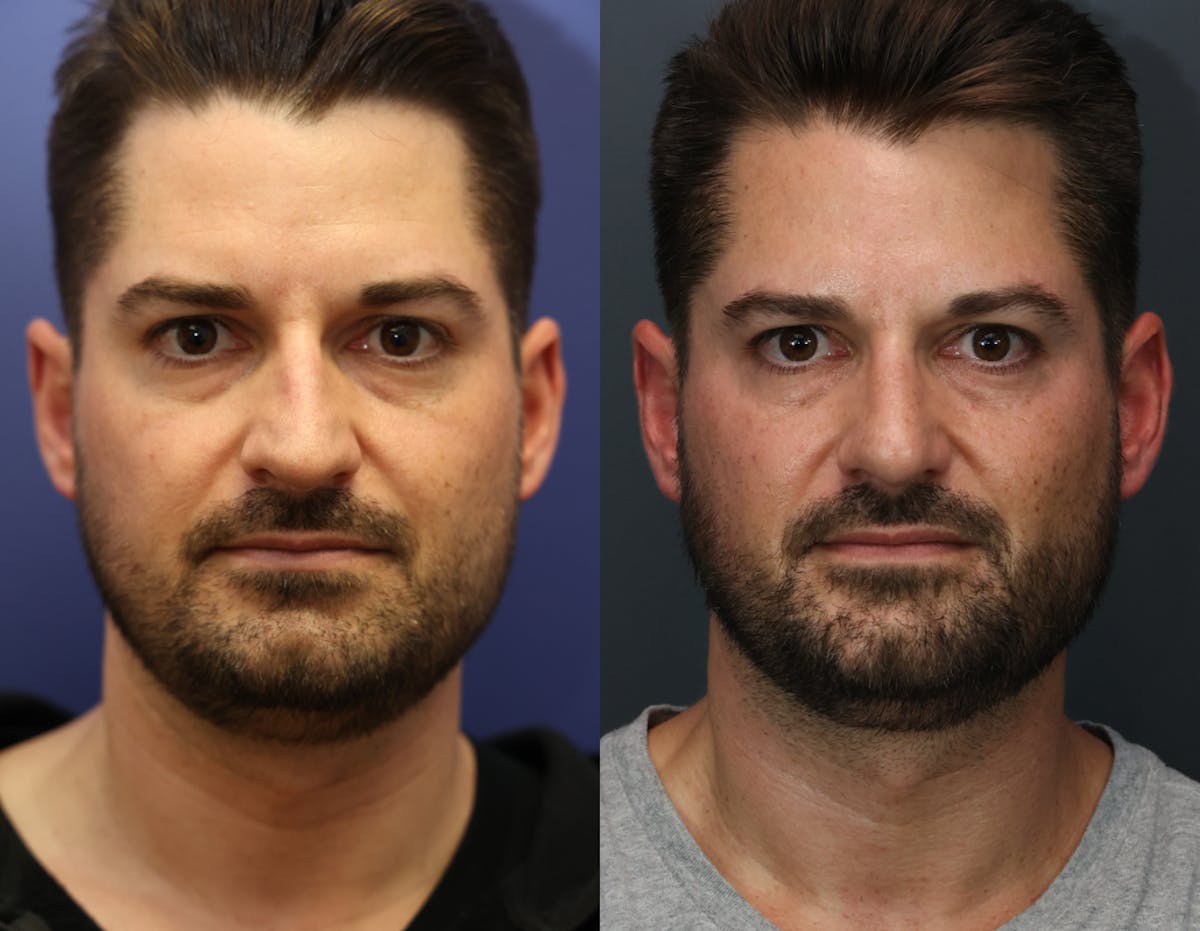 Rhinoplasty Before & After Gallery - Patient 381950 - Image 1