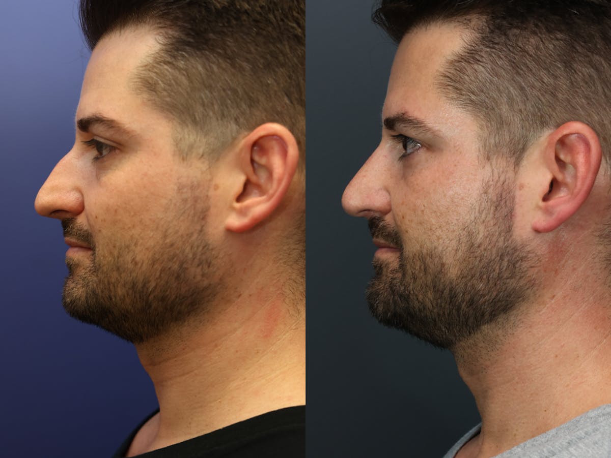 Rhinoplasty Before & After Gallery - Patient 381950 - Image 3