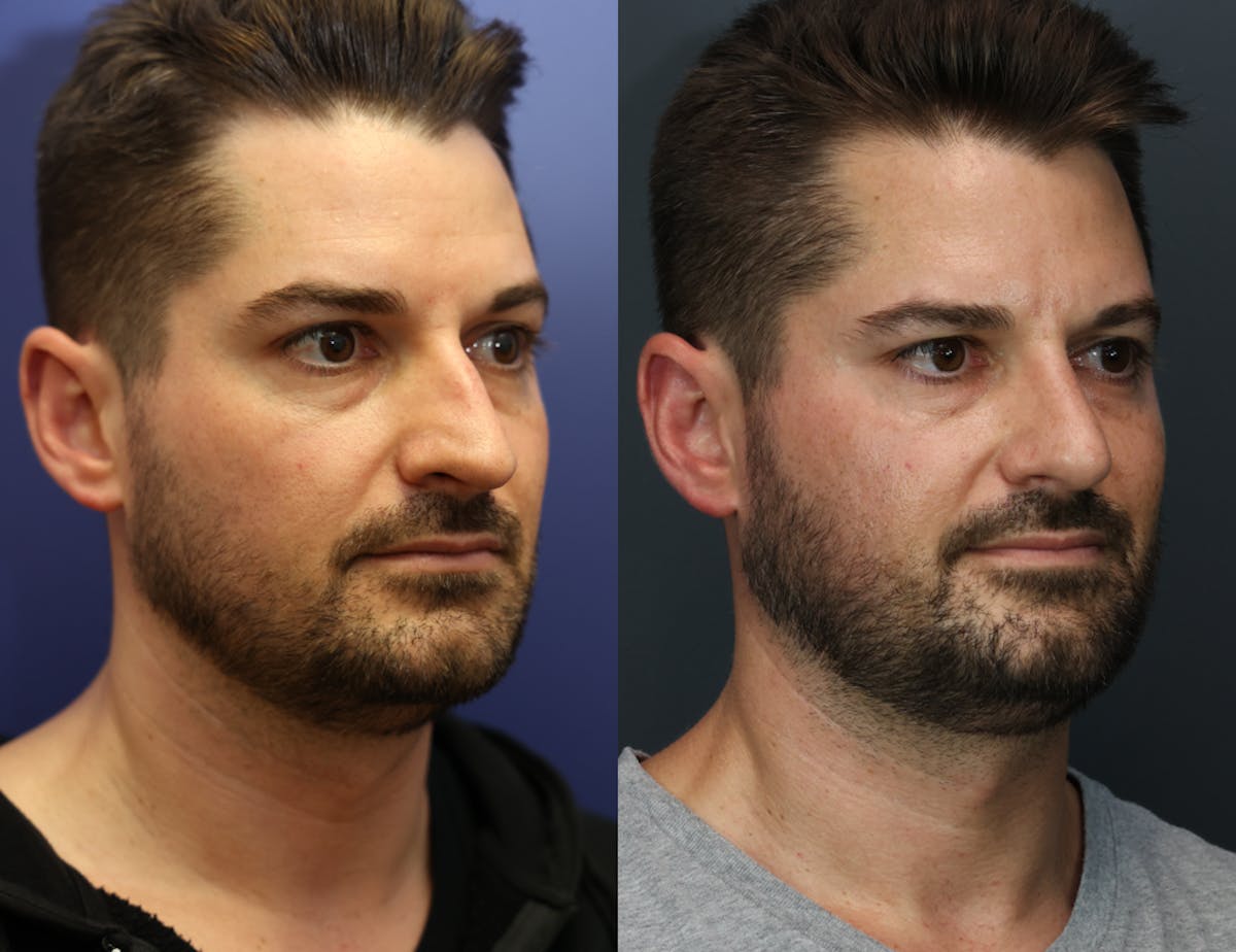 Rhinoplasty Before & After Gallery - Patient 381950 - Image 4
