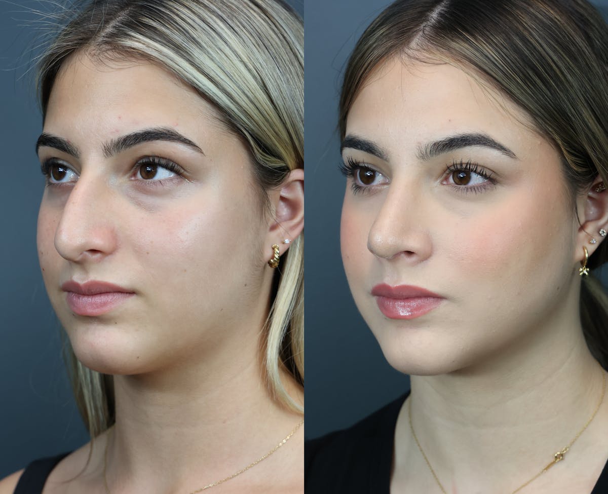 Rhinoplasty Before & After Gallery - Patient 221070 - Image 1