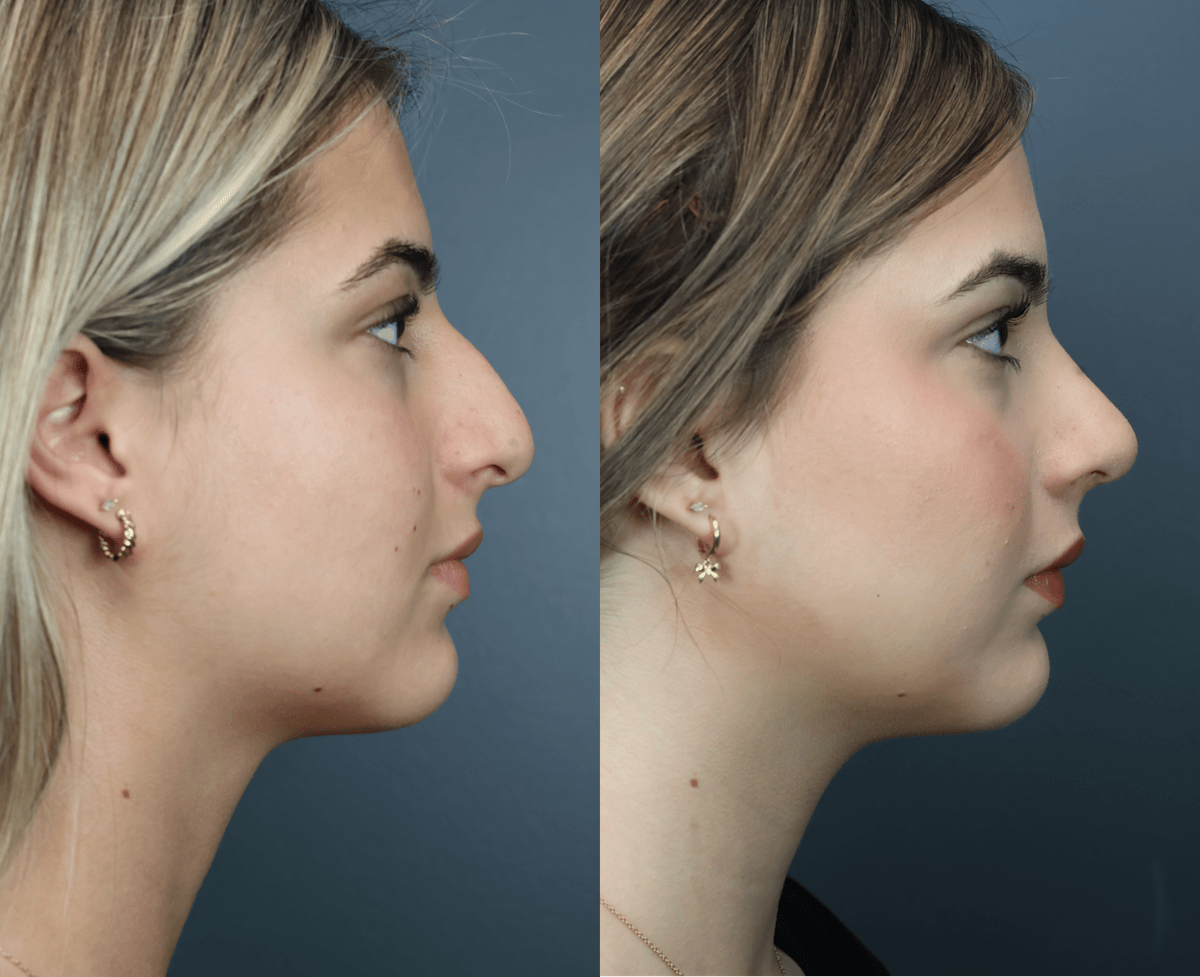 Rhinoplasty Before & After Gallery - Patient 221070 - Image 3