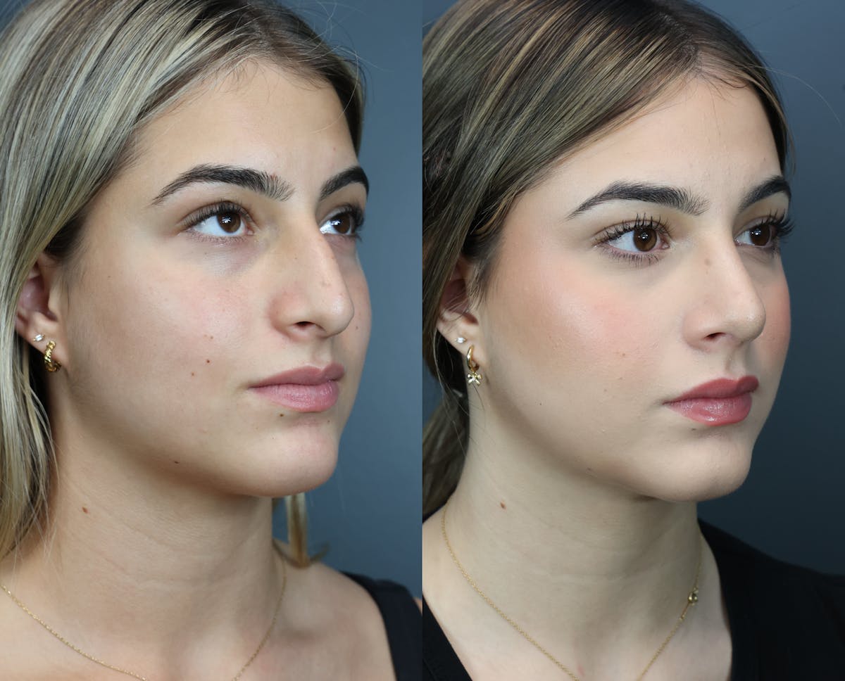 Rhinoplasty Before & After Gallery - Patient 221070 - Image 4