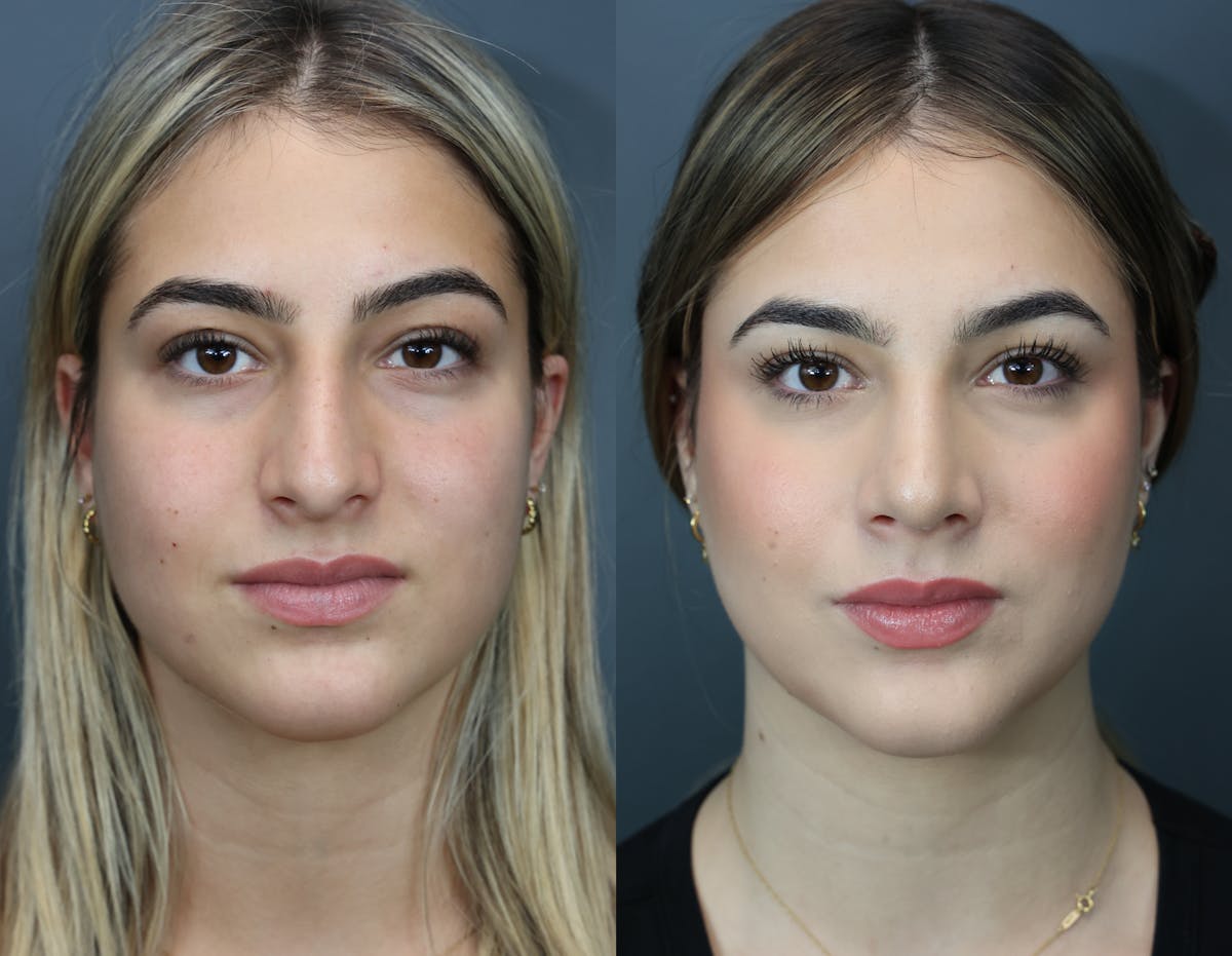 Rhinoplasty Before & After Gallery - Patient 221070 - Image 5