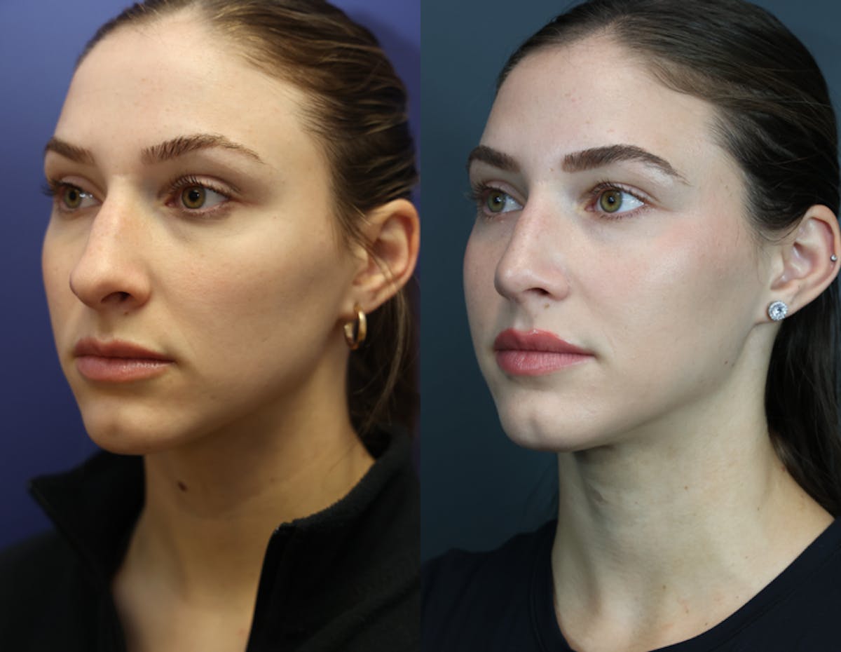 Rhinoplasty Before & After Gallery - Patient 250930 - Image 1