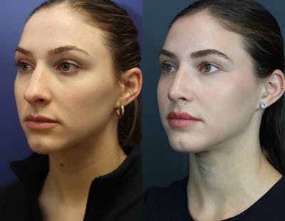 Rhinoplasty Before & After Gallery - Patient 250930 - Image 1