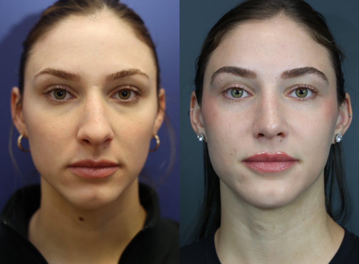 Rhinoplasty Before & After Gallery - Patient 250930 - Image 3