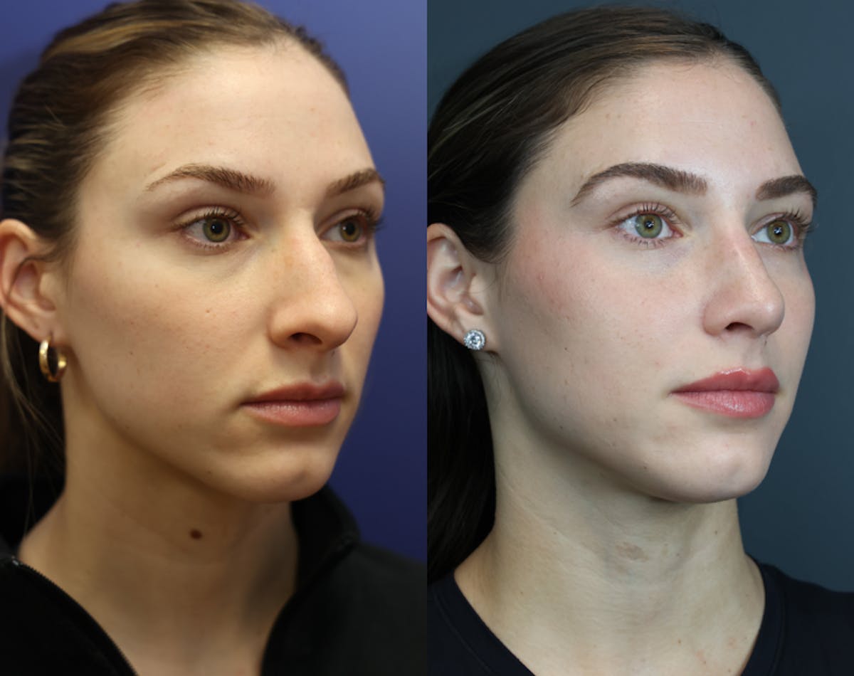 Rhinoplasty Before & After Gallery - Patient 250930 - Image 4