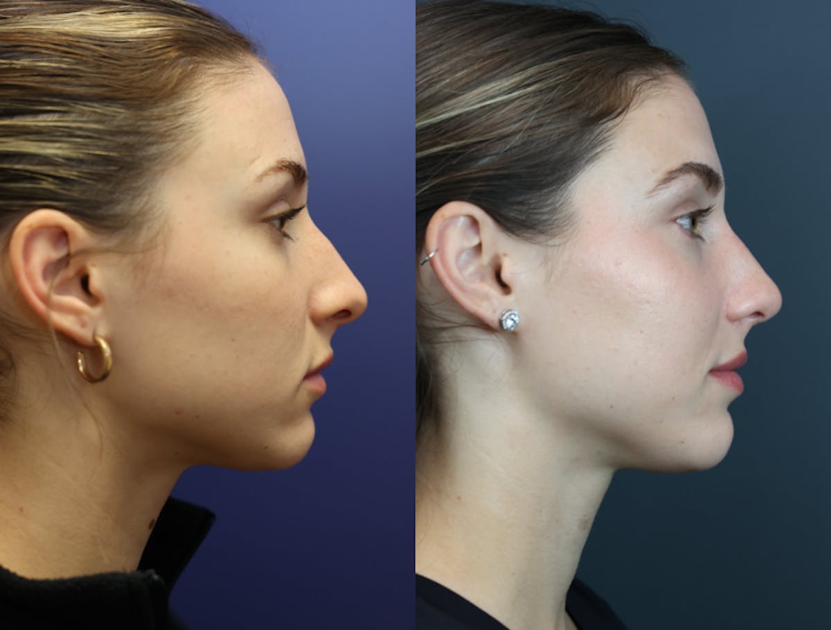 Rhinoplasty Before & After Gallery - Patient 250930 - Image 5