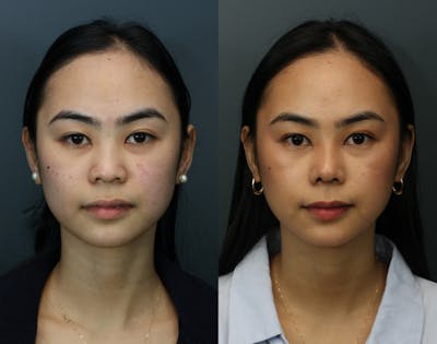 Rhinoplasty Before & After Gallery - Patient 661312 - Image 1