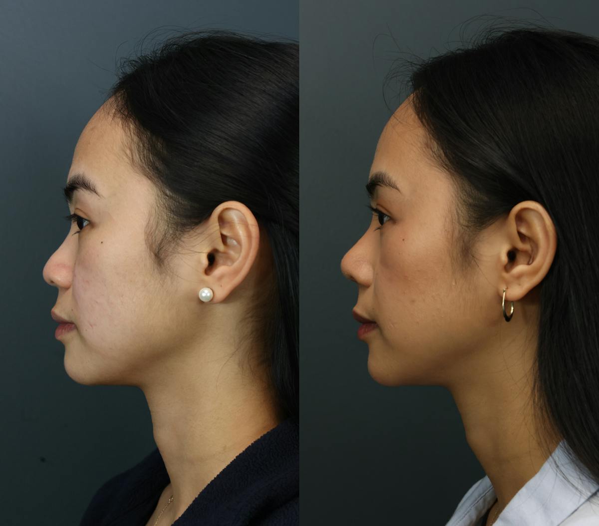 Rhinoplasty Before & After Gallery - Patient 661312 - Image 4
