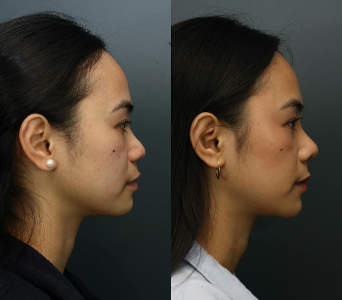 Rhinoplasty Before & After Gallery - Patient 661312 - Image 5