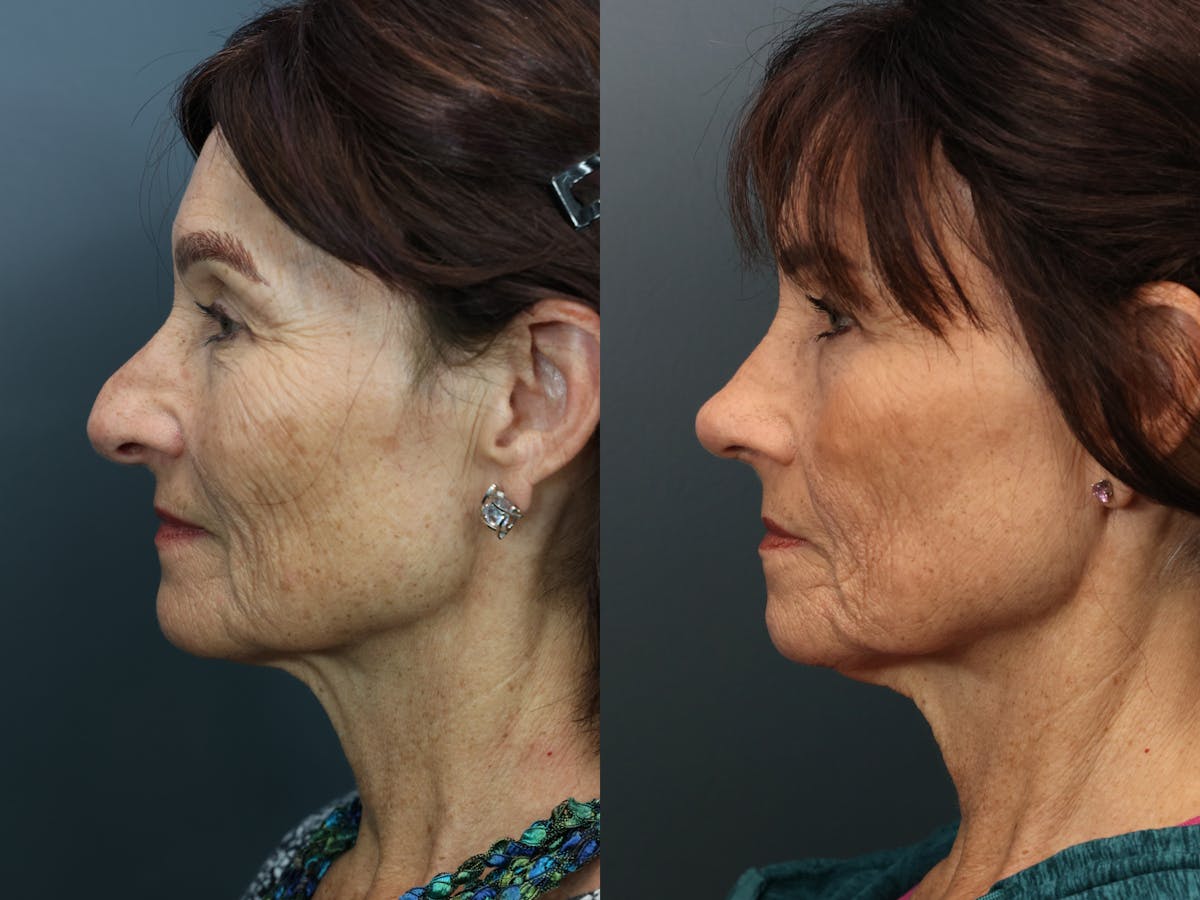 Rhinoplasty Before & After Gallery - Patient 252130 - Image 1