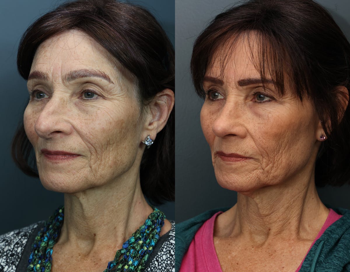 Rhinoplasty Before & After Gallery - Patient 252130 - Image 2