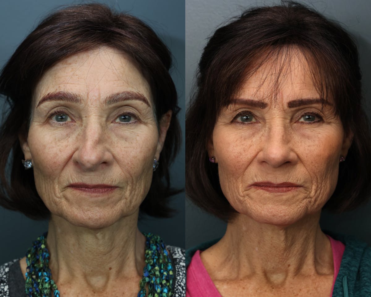 Rhinoplasty Before & After Gallery - Patient 252130 - Image 3