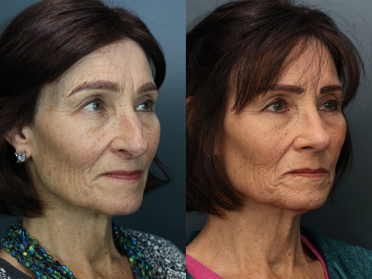 Rhinoplasty Before & After Gallery - Patient 252130 - Image 4