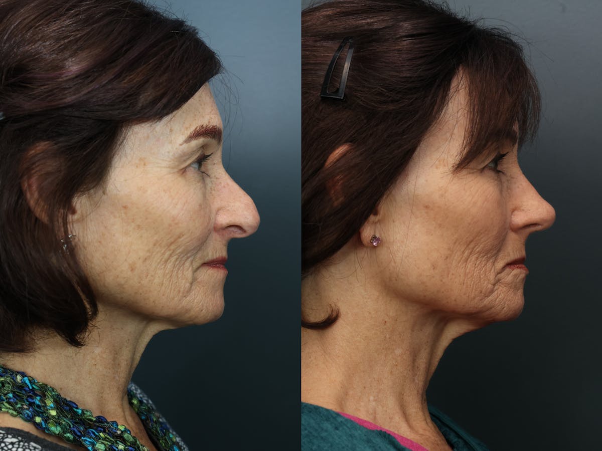 Rhinoplasty Before & After Gallery - Patient 252130 - Image 5