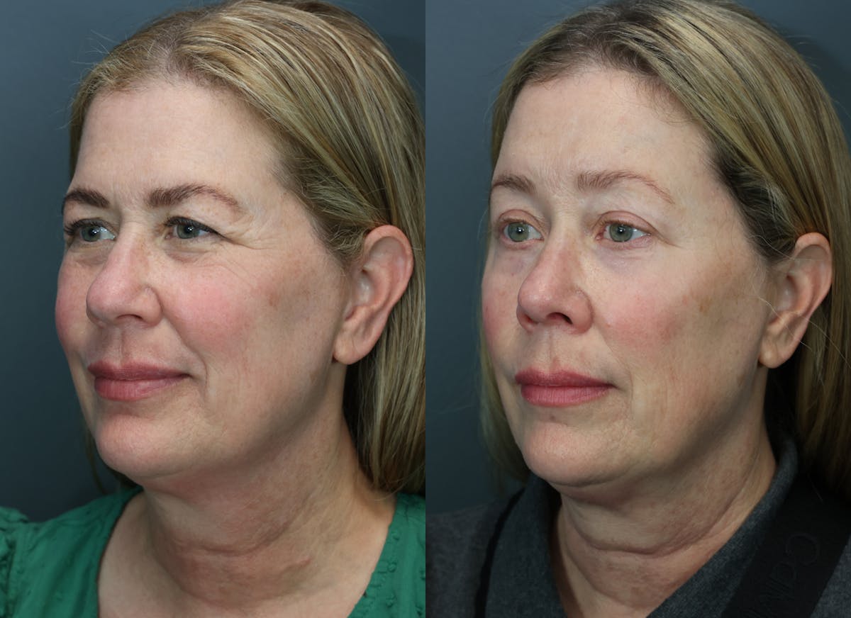 Rhinoplasty Before & After Gallery - Patient 104221 - Image 1