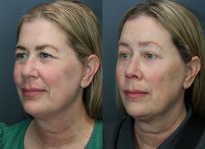 Rhinoplasty Before & After Gallery - Patient 104221 - Image 1