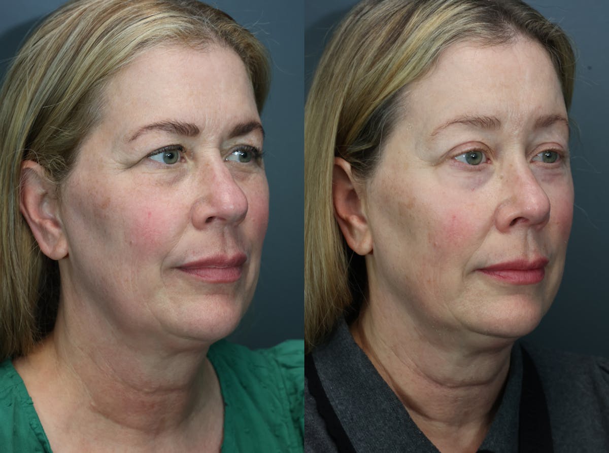 Rhinoplasty Before & After Gallery - Patient 104221 - Image 2