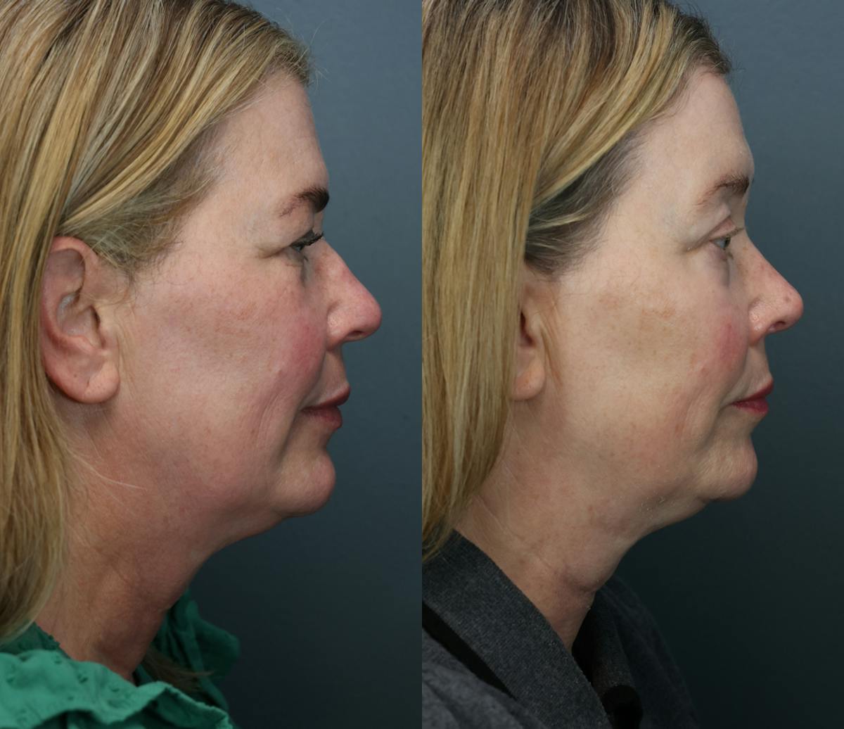 Rhinoplasty Before & After Gallery - Patient 104221 - Image 3