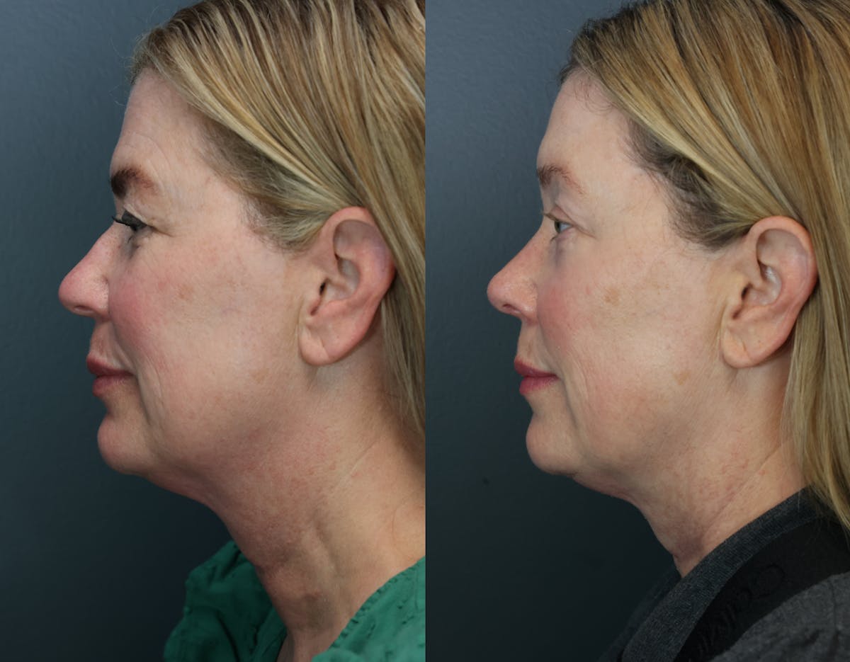 Rhinoplasty Before & After Gallery - Patient 104221 - Image 4