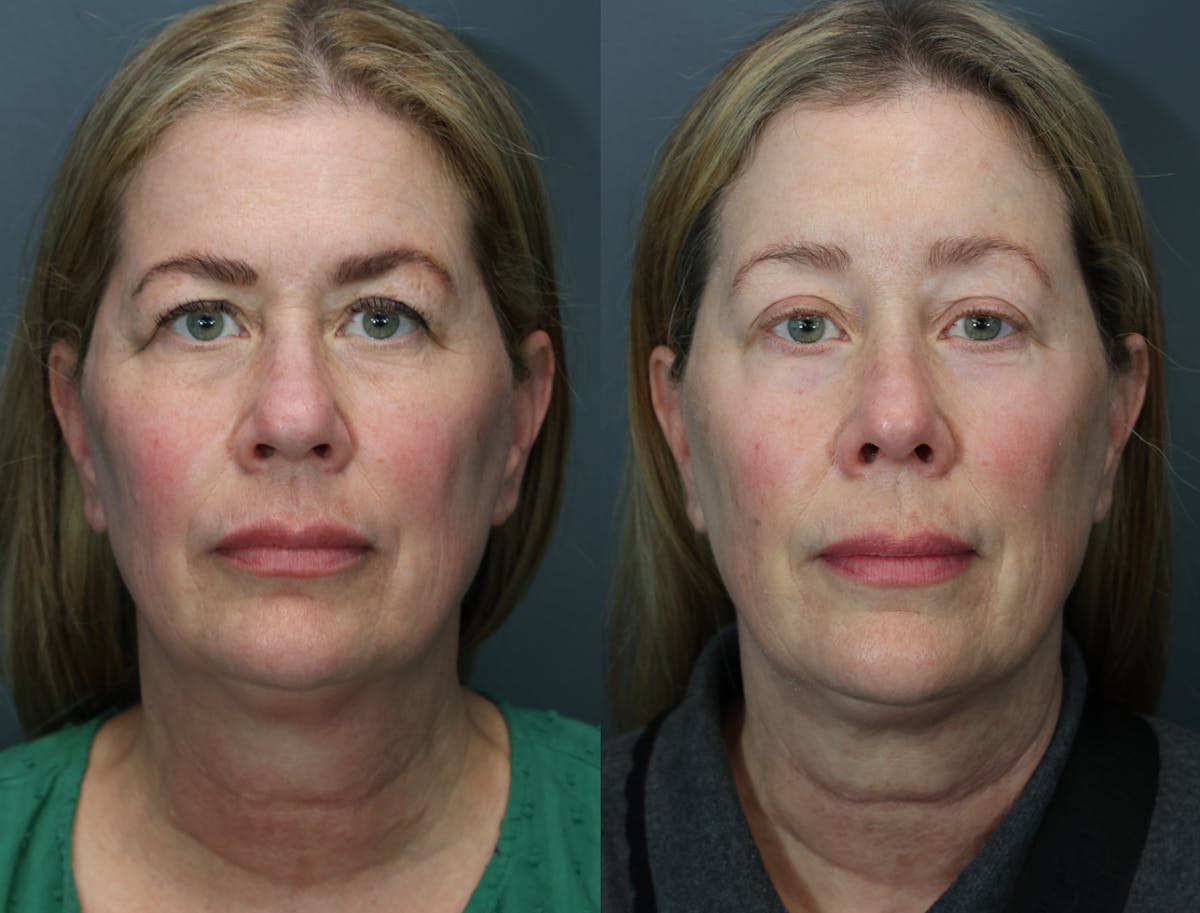 Rhinoplasty Before & After Gallery - Patient 104221 - Image 5