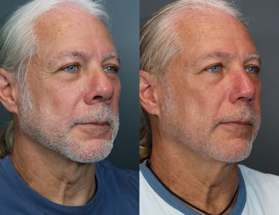 Rhinoplasty Before & After Gallery - Patient 243504 - Image 1