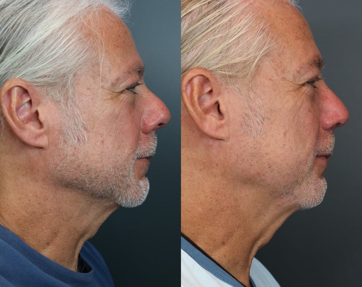 Rhinoplasty Before & After Gallery - Patient 243504 - Image 3