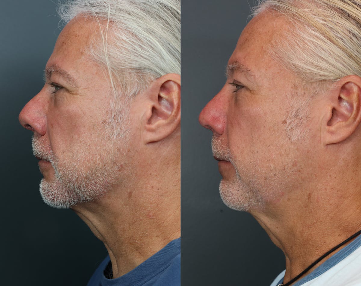 Rhinoplasty Before & After Gallery - Patient 243504 - Image 4