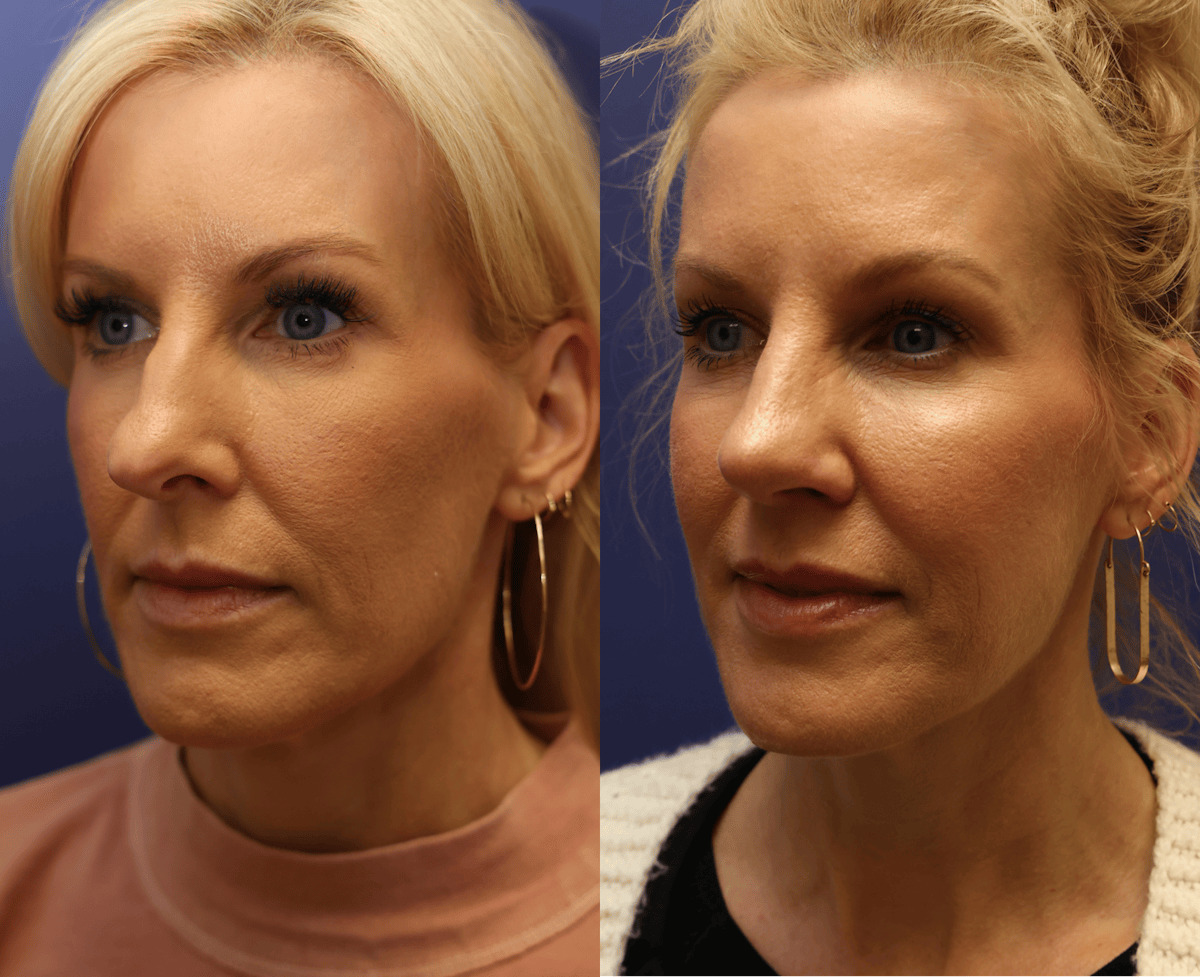 Rhinoplasty Before & After Gallery - Patient 337267 - Image 2