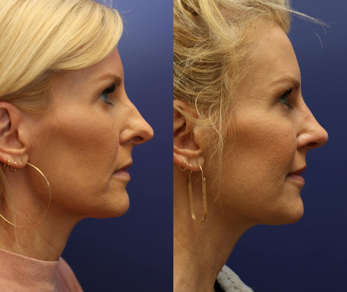 Rhinoplasty Before & After Gallery - Patient 337267 - Image 3