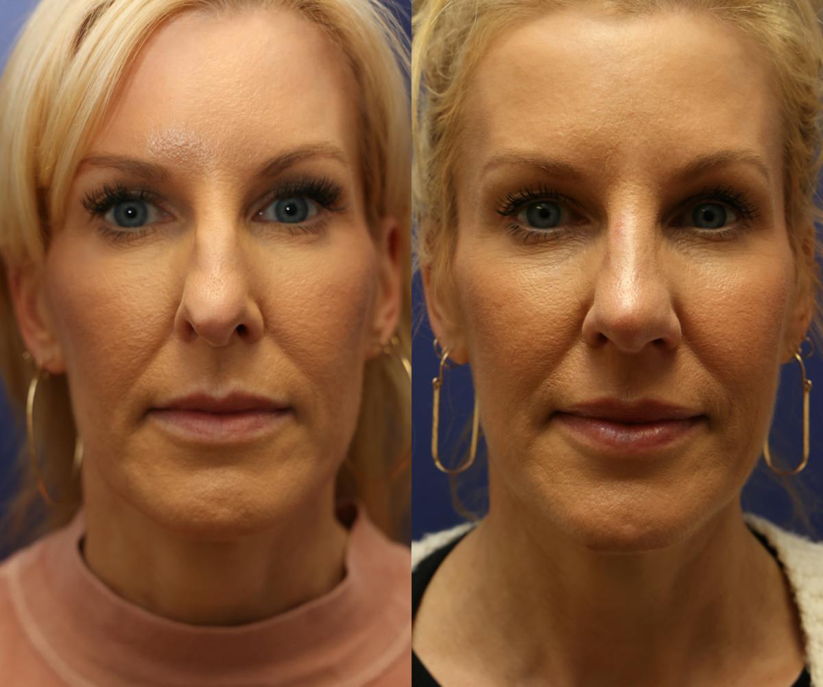 Rhinoplasty Before & After Gallery - Patient 337267 - Image 5