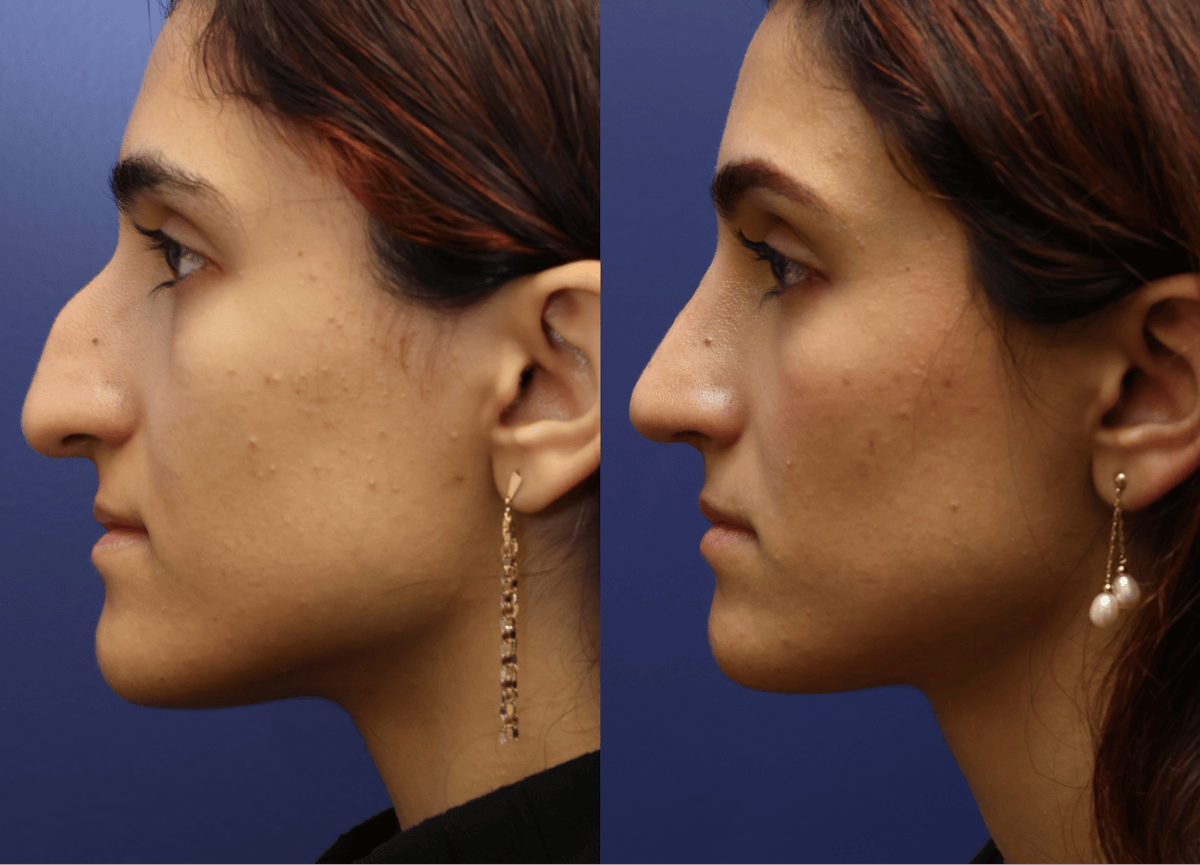 Rhinoplasty Before & After Gallery - Patient 799066 - Image 1