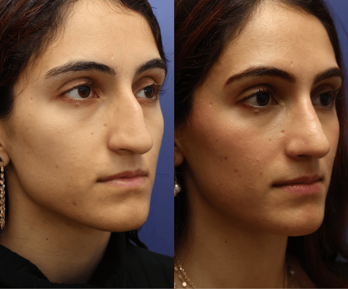 Rhinoplasty Before & After Gallery - Patient 799066 - Image 2