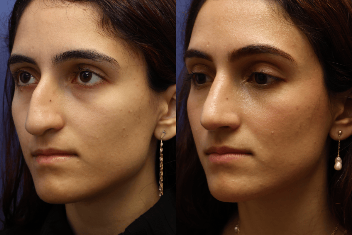 Rhinoplasty Before & After Gallery - Patient 799066 - Image 3