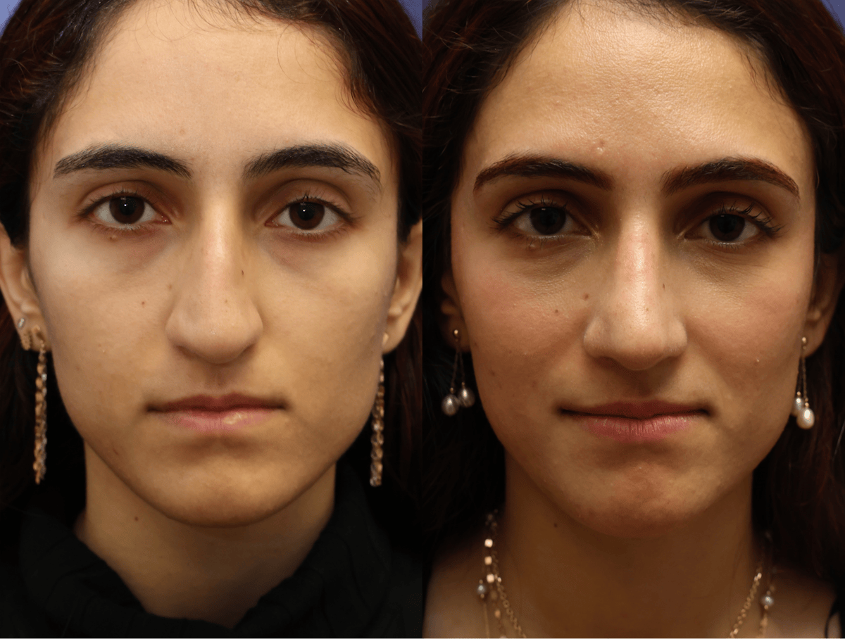 Rhinoplasty Before & After Gallery - Patient 799066 - Image 4