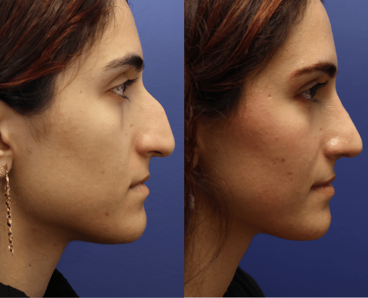 Rhinoplasty Before & After Gallery - Patient 799066 - Image 5