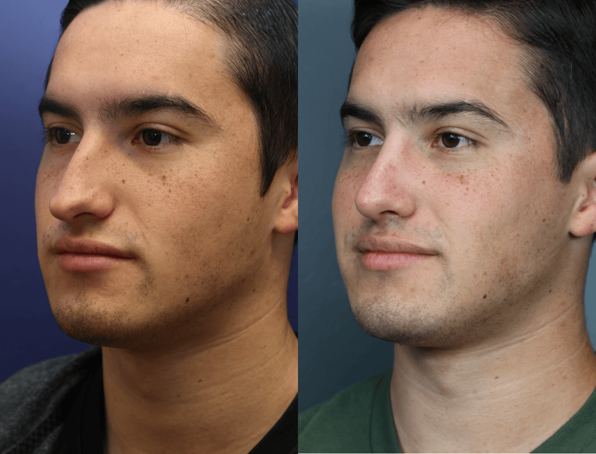 Rhinoplasty Before & After Gallery - Patient 313229 - Image 2