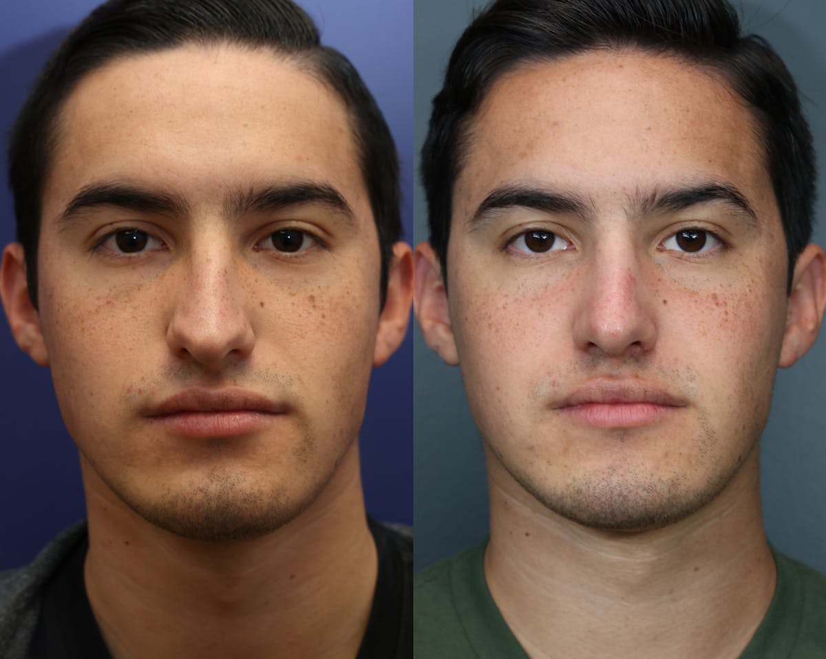 Rhinoplasty Before & After Gallery - Patient 313229 - Image 3