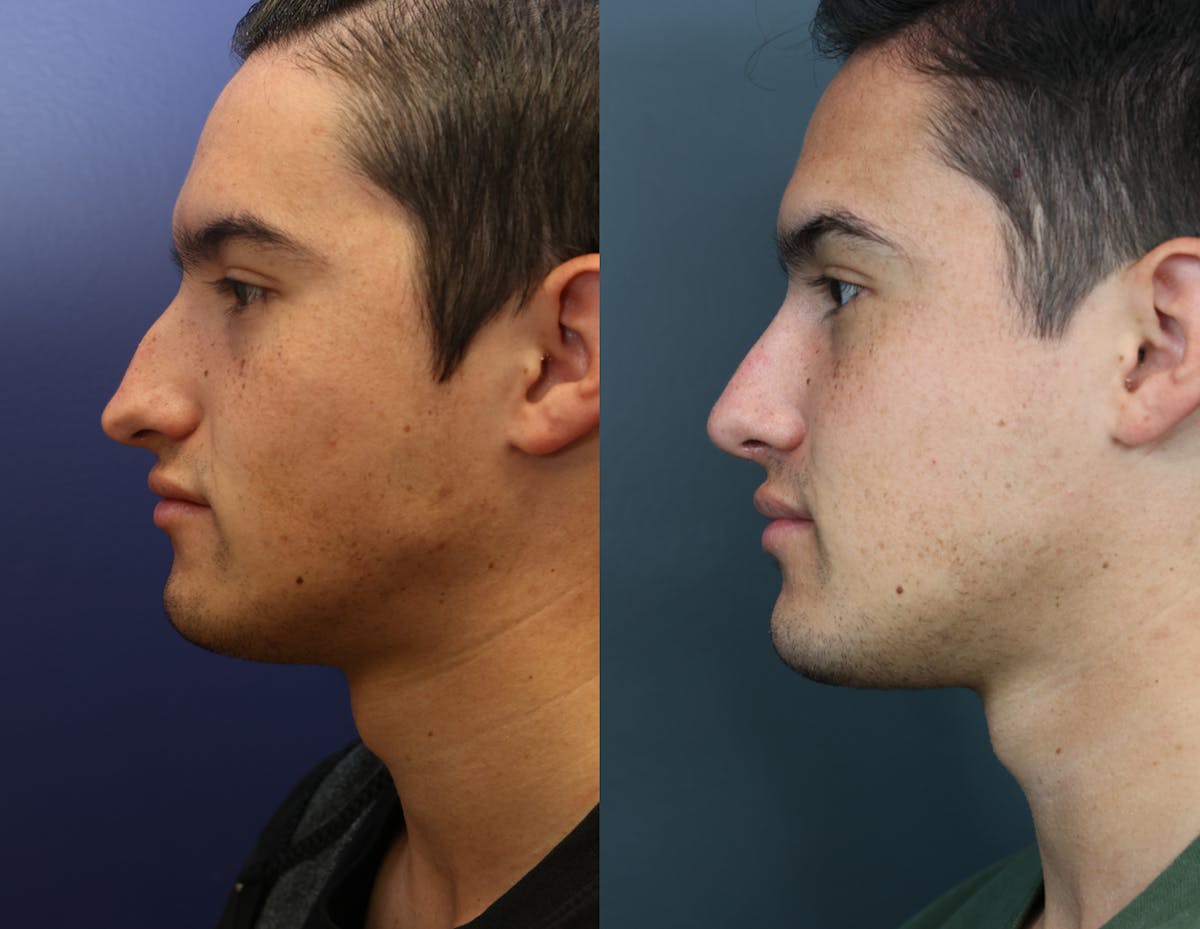 Rhinoplasty Before & After Gallery - Patient 313229 - Image 4