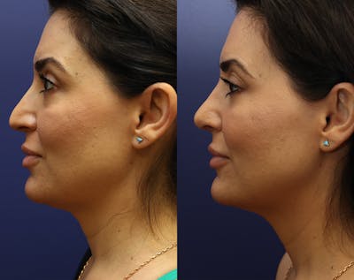Rhinoplasty Before & After Gallery - Patient 162582 - Image 1