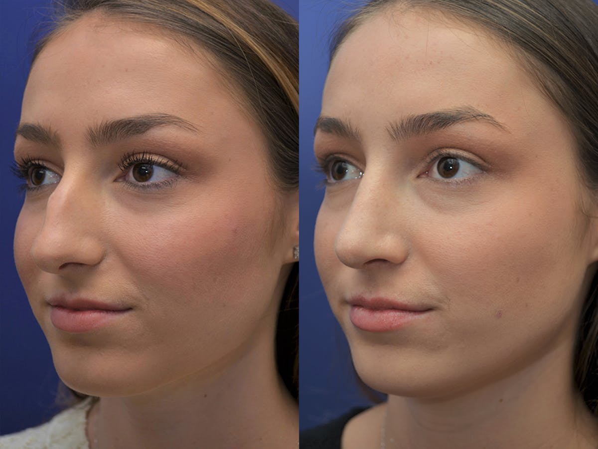 Rhinoplasty Before & After Gallery - Patient 205286 - Image 1
